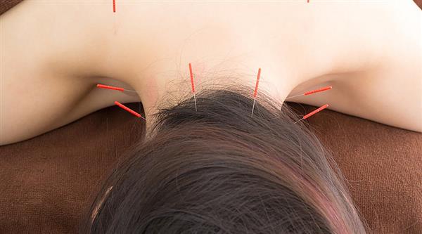 中醫(yī)針灸有何療效？石家莊炎黃針灸推拿學校為你分享！